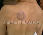 儿童白癜风典型症状二