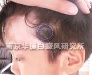 儿童白癜风典型症状三
