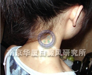 儿童白癜风典型症状四