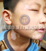 儿童白癜风症状表现一