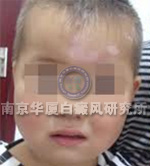 儿童白癜风症状表现二