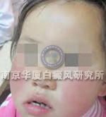 儿童白癜风症状表现三