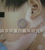 儿童白癜风症状表现四
