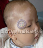 儿童白癜风症状表现五