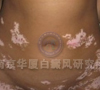 危害一:并发症