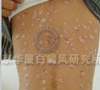 危害三:皮肤癌