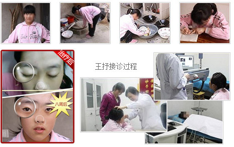十大康复案例之— ——“白雪公主”的美丽蜕变