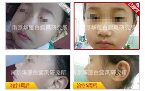 十大康复案例之九 ——“小花猫”变公主,玲玲治疗白癜风治疗