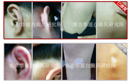 十大康复案例之四 ——青春发育期爆发白癜风,华厦拯救白斑少女