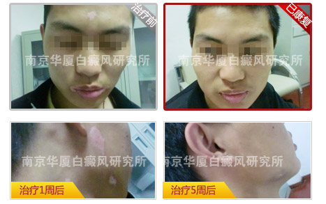 十大康复案例之五 ——十年白斑路,最终小伙赢回妻子