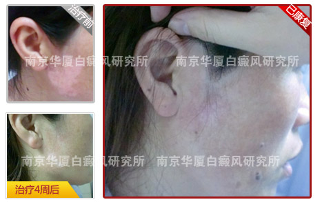 十大康复案例之六 ——小白斑不知不觉养三年,科研学者的白癜风治疗路