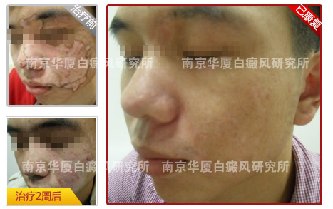 十大康复案例之八 ——喝酒应酬诱白斑 华夏让小伙重返职场